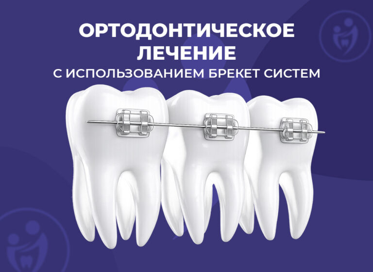 ортодонтическое лечение с брекетами
